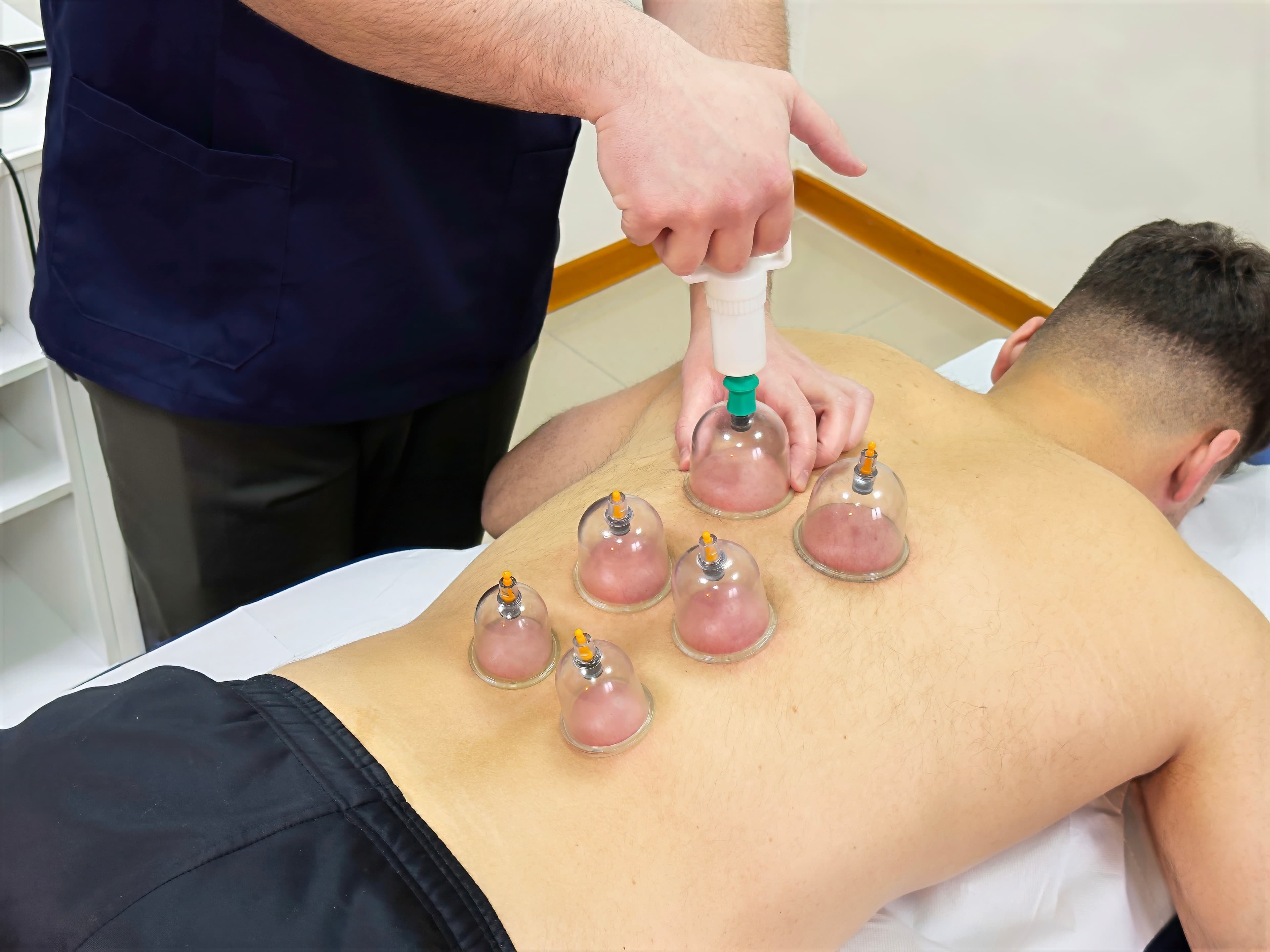 Trattamento di coppettazione